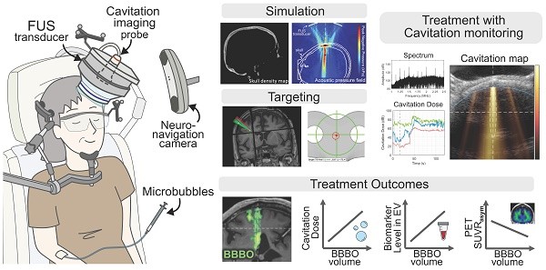Summary of the clinical transducer setup, simulation, targeting, treatment monitoring and outcomes of the study.