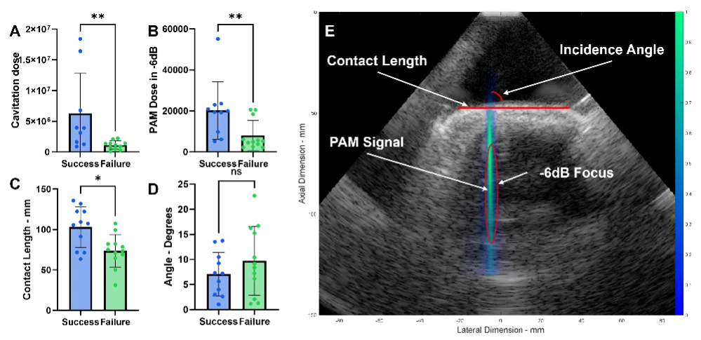 Figure of ultrasound metrics in successful and failed cases of FUS-BBBO in pediatric DMG patients.